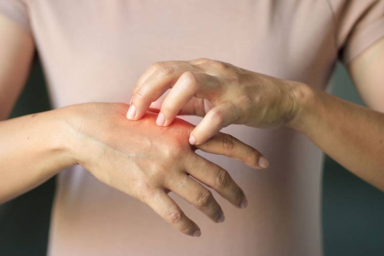 Psoriasis : Symptômes, Ursachen & Traitements